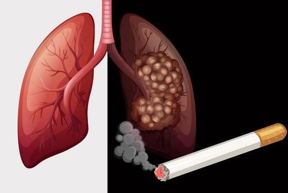 smoker's lungs and healthy lungs