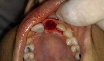 the location of the extracted tooth